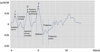 Automatic Recognition of Auditory Brainstem Response Characteristic Waveform Based on Bidirectional Long Short-Term Memory